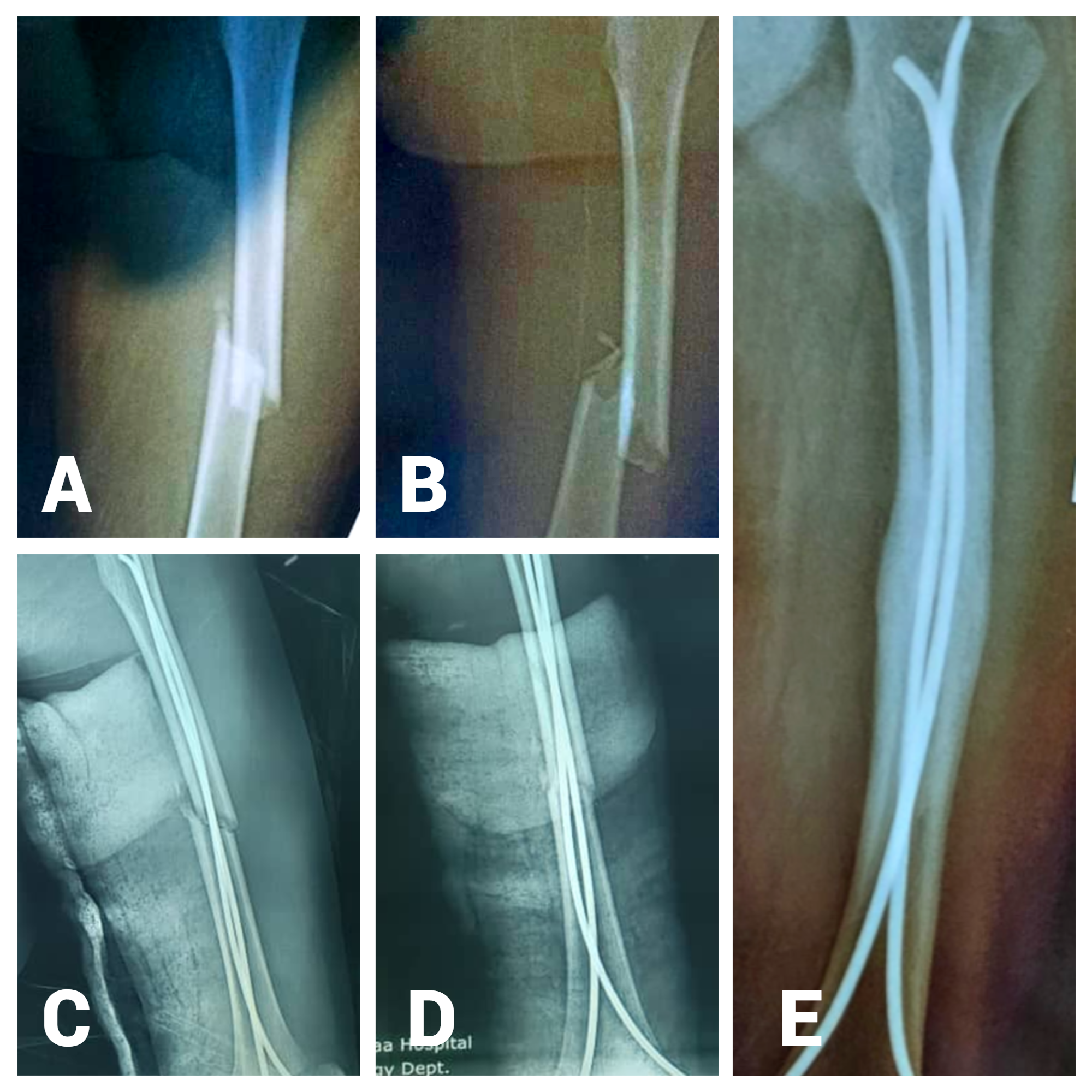  Radiographs of a 9-year-old male with a left femoral shaft fracture treated with TENS. (A) Anteroposterior (AP) and (B) lateral preoperative radiographs showing a transverse fracture of the femoral shaft. (C) AP and (D) lateral immediate postoperative radiographs demonstrate excellent alignment and reduction with two TENS nails. (E) Follow-up AP radiograph at 12 weeks showing bridging callus formation, indicating solid fracture union.